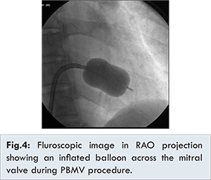 Severe Rheumatic Mitral Stenosis in Marfanoid Young Man Successfully